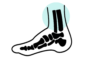 douleur cheville interne externne specialiste operation pied cheville dr nicolas baudrier paris chirurgien orthopediste traumatologue specialiste pied cheville paris