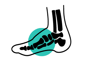 operation du pied convalescence specialiste operation pied cheville dr nicolas baudrier paris chirurgien orthopediste traumatologue specialiste pied cheville paris