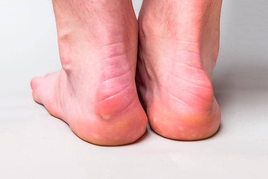 maladie de haglund maladie professionnelle dr baudrier nicolas chirurgien orthopédiste et traumatologue cheville et pied paris