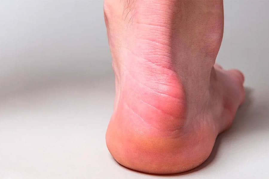 maladie de haglund tendon d'achille dr baudrier nicolas chirurgien orthopédiste et traumatologue cheville et pied paris