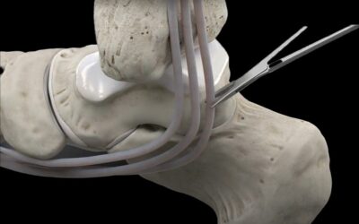 Le transfert du tendon FHL