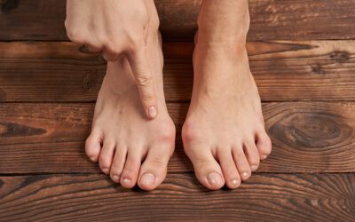 C’est quoi l’Hallux Valgus ?