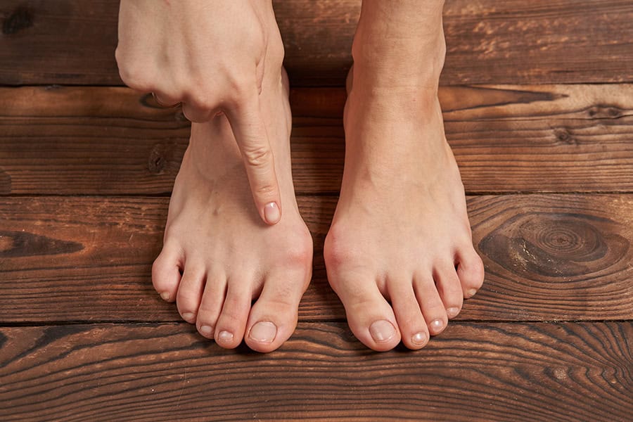 hallux valgus c est quoi dr baudrier nicolas dr shitrit chirurgien orthopédiste et traumatologue cheville et pied paris