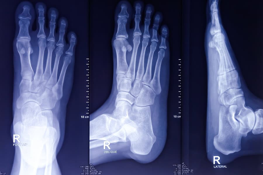 Syndrome de l’os trigone : définition et causes
